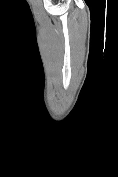 File:Aortic coarctation with aneurysm (Radiopaedia 74818-85828 B 6).jpg