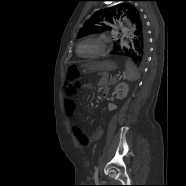 File:Aortic dissection (Radiopaedia 28802-29105 C 1).jpg