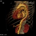 Aortic dissection with rupture into pericardium (Radiopaedia 12384-12647 C+ arterial phase 32).jpg