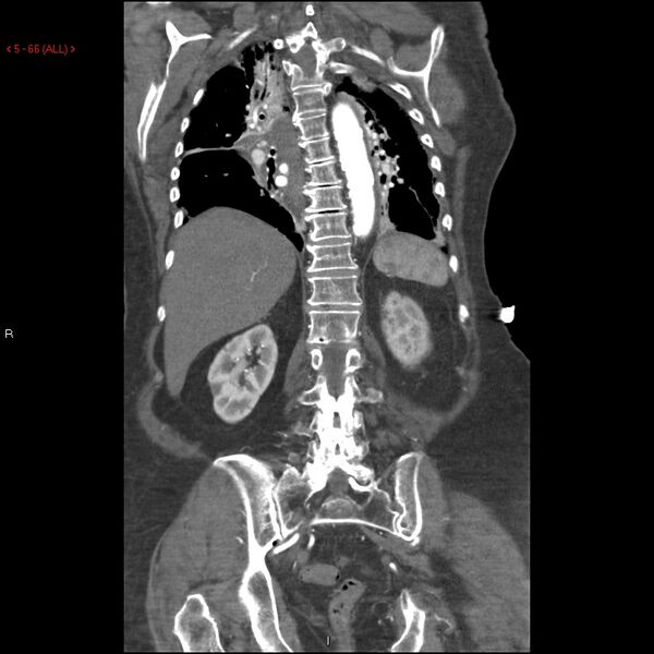 File:Aortic intramural hematoma (Radiopaedia 27746-28001 B 43).jpg