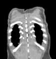 Aortic valve non-coronary cusp thrombus (Radiopaedia 55661-62189 C 73).png