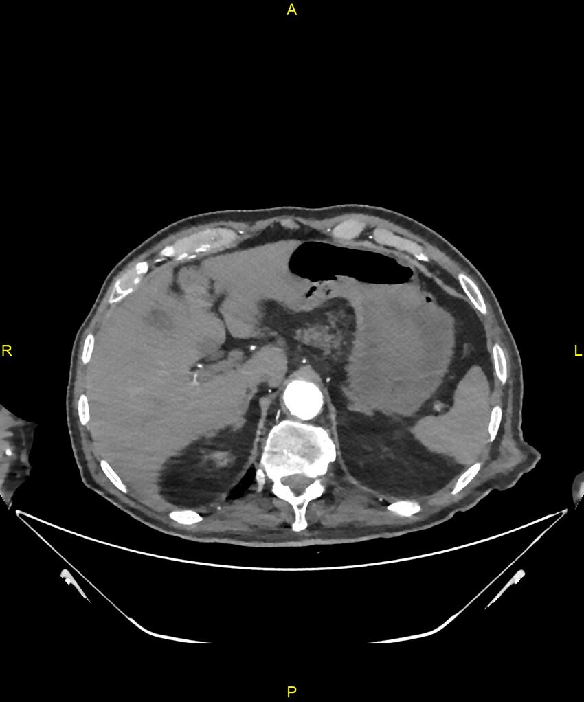 Aortoenteric fistula (Radiopaedia 84308-99603 B 62).jpg