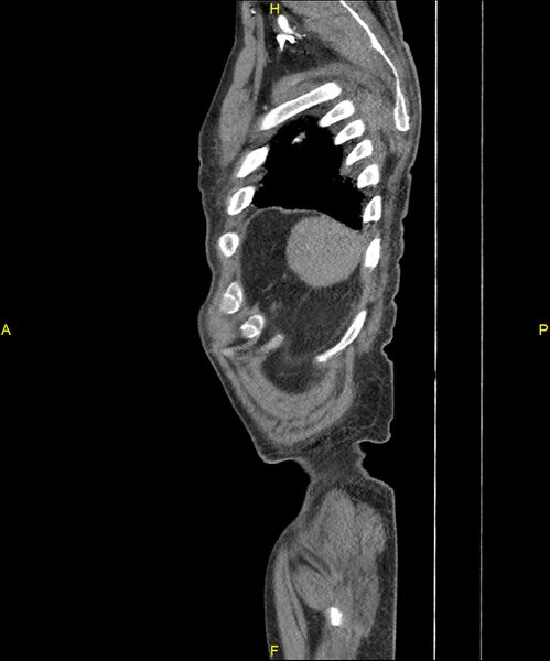 File:Aortoenteric fistula (Radiopaedia 84308-99603 C 312).jpg