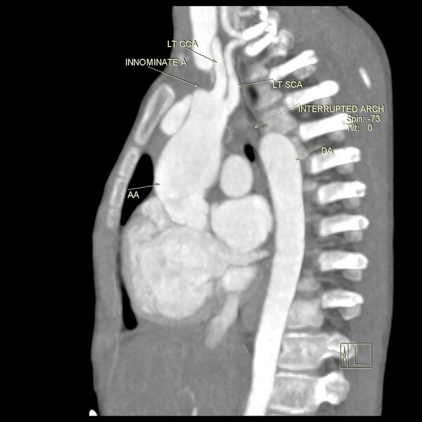 File:Aortopulmonary window, interrupted aortic arch and large PDA giving the descending aorta (Radiopaedia 35573-37077 Sagittal +C 1).jpg