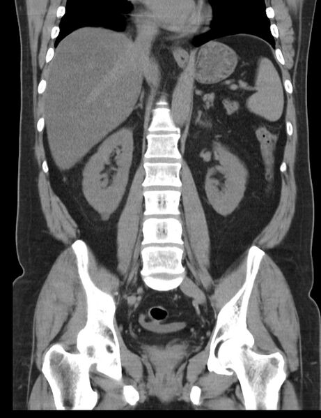File:Appendicitis and giant appendicolith (Radiopaedia 80251-93588 Coronal non-contrast 29).jpg