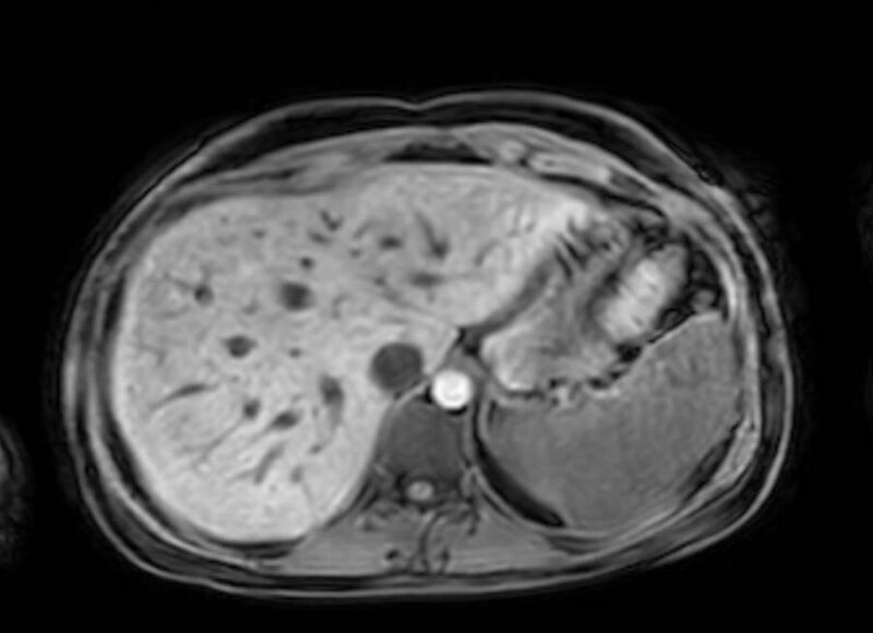 File:Appendicitis in gravida (MRI) (Radiopaedia 89433-106395 Axial DIXON 18).jpg