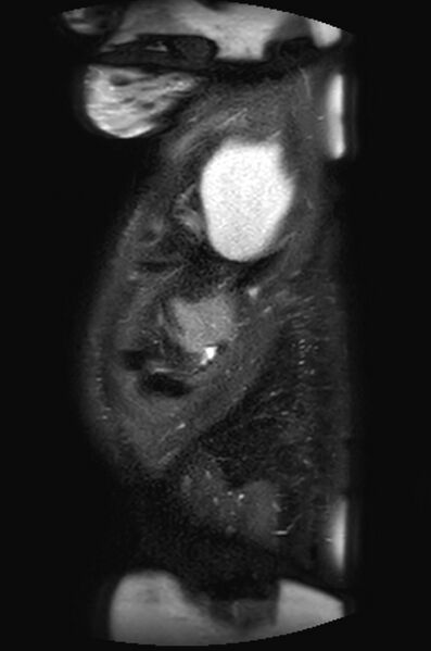 File:Appendicitis in gravida (MRI) (Radiopaedia 89433-106395 Sagittal T2 SPAIR 5).jpg