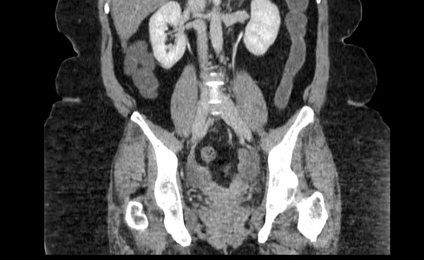 Appendix mucocele (Radiopaedia 41222-44033 B 54).jpg