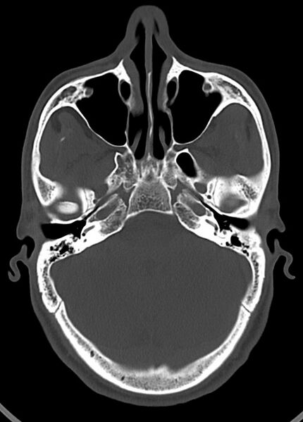 File:Arrow injury to the head (Radiopaedia 75266-86388 Axial bone window 52).jpg