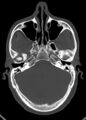Arrow injury to the head (Radiopaedia 75266-86388 Axial bone window 52).jpg