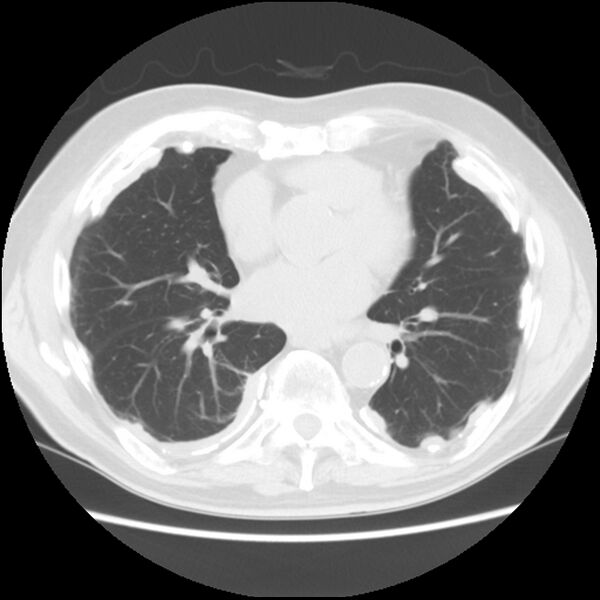 File:Asbestos-related pleural plaques (Radiopaedia 39069-41255 Axial lung window 44).jpg
