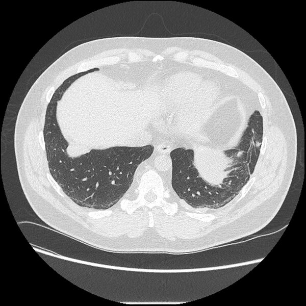 File:Asbestosis (Radiopaedia 45002-48961 Axial lung window 38).jpg