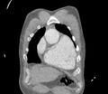 Ascending aortic aneurysm (Radiopaedia 86279-102297 B 6).jpg