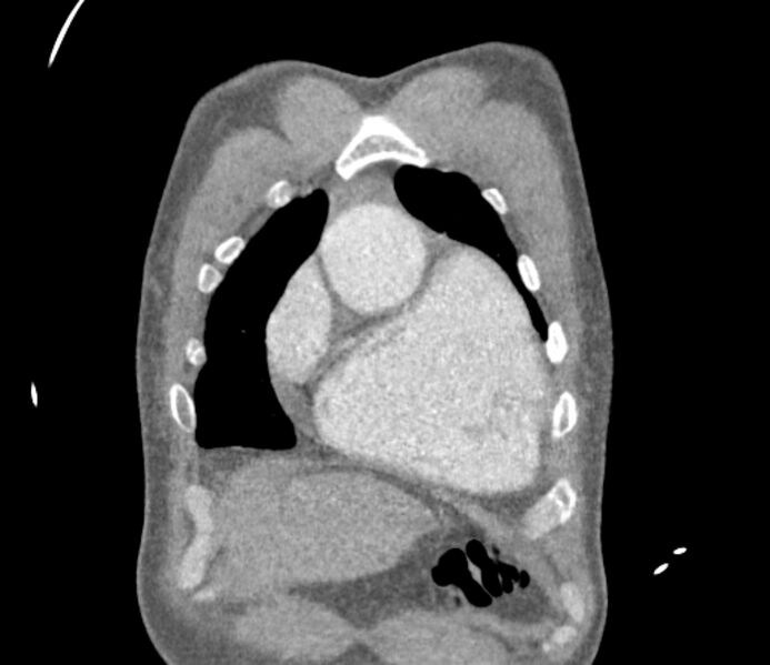 File:Ascending aortic aneurysm (Radiopaedia 86279-102297 B 6).jpg