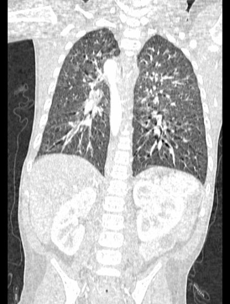 File:Asplenia syndrome (Radiopaedia 73083-83792 Coronal lung window 95).jpg
