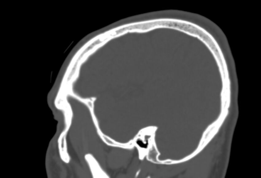 Asymptomatic occipital spur (Radiopaedia 87753-104201 Sagittal bone window 249).jpg