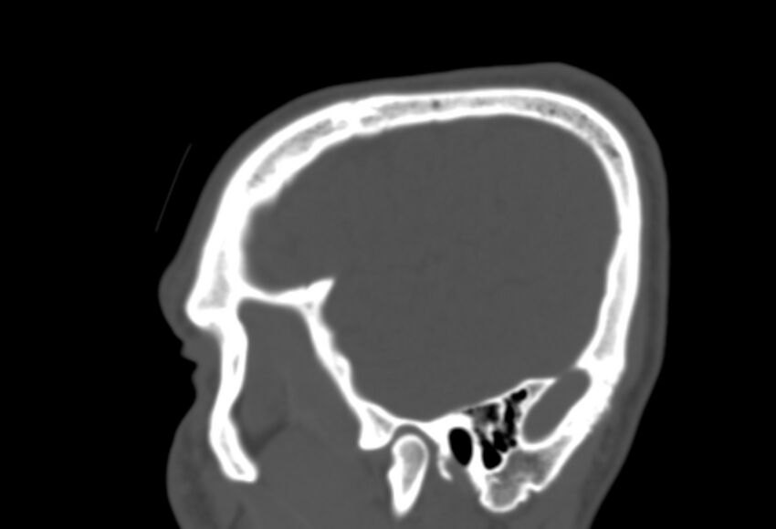 Asymptomatic occipital spur (Radiopaedia 87753-104201 Sagittal bone window 37).jpg