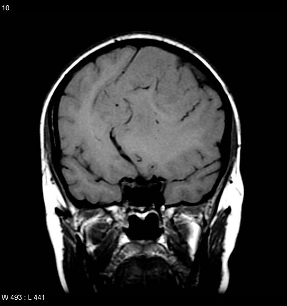 File:Atypical meningioma (WHO grade II) (Radiopaedia 7762-8586 Coronal T1 1).jpg
