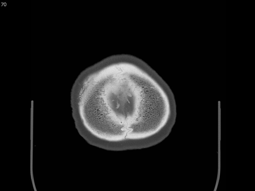 Atypical meningioma - intraosseous (Radiopaedia 64915-73867 Axial C+ bone window 70).jpg