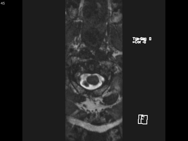 File:Atypical meningioma - intraosseous (Radiopaedia 64915-74572 Axial CISS 45).jpg