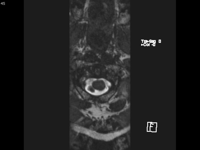 Atypical meningioma - intraosseous (Radiopaedia 64915-74572 Axial CISS 45).jpg