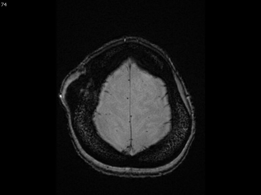 Atypical meningioma - intraosseous (Radiopaedia 64915-74572 Axial SWI 74).jpg