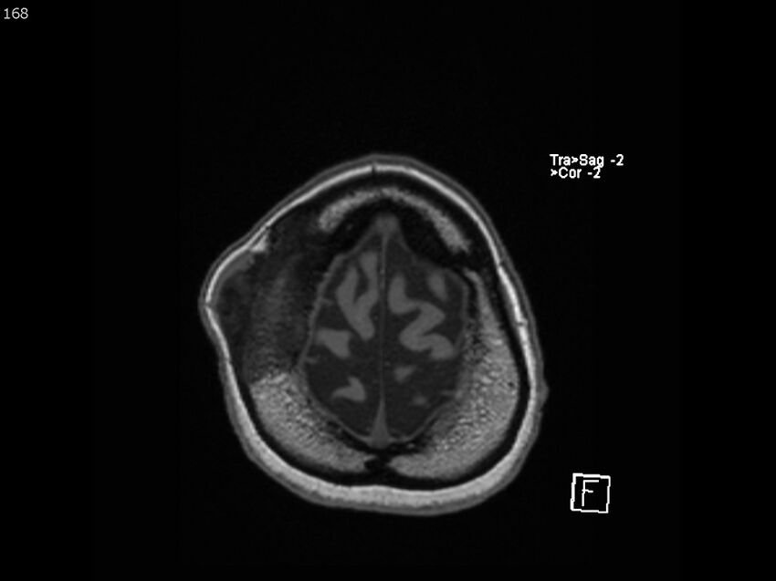 Atypical meningioma - intraosseous (Radiopaedia 64915-74572 Axial T1 168).jpg