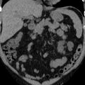 Autosomal dominant polycystic kidney disease (Radiopaedia 36539-38101 Coronal non-contrast 8).jpg