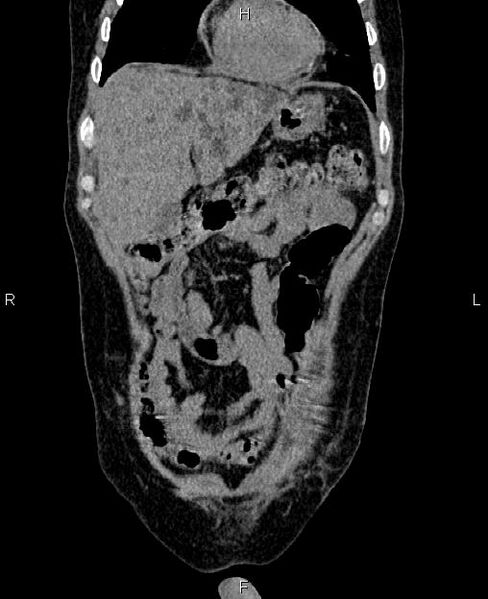 File:Autosomal dominant polycystic kidney disease (Radiopaedia 87830-104287 Coronal non-contrast 8).jpg