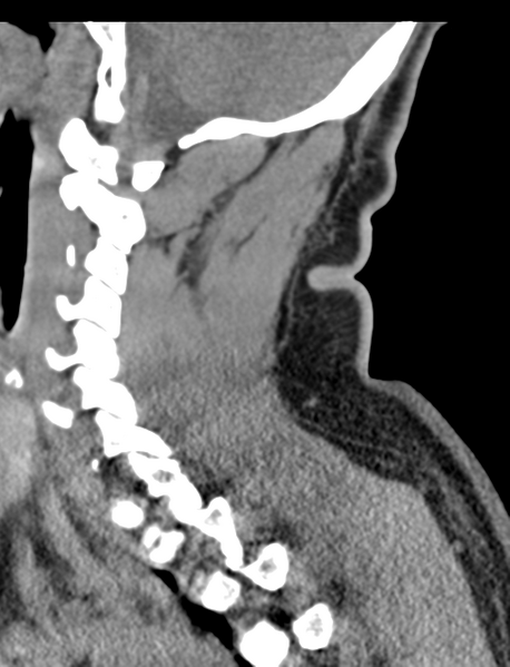 File:Axis peg fracture (type 3) and atlas lateral mass (type 4) fracture (Radiopaedia 37474-39324 D 28).png