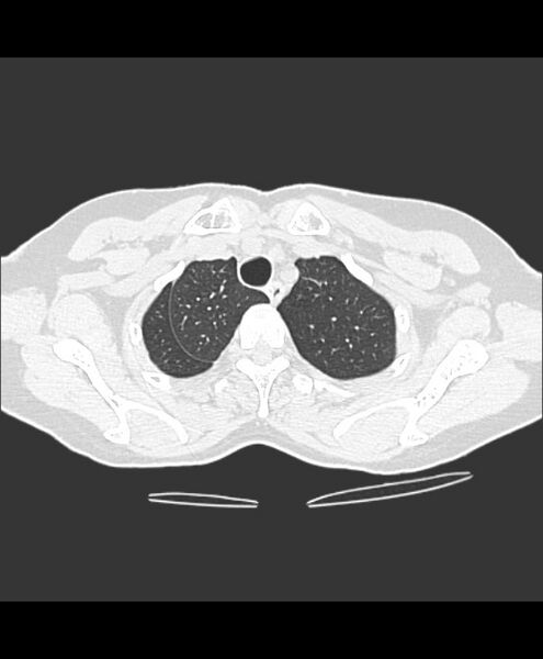 File:Azygos fissure and azygos lobe (Radiopaedia 41841-44832 Axial lung window 30).jpg