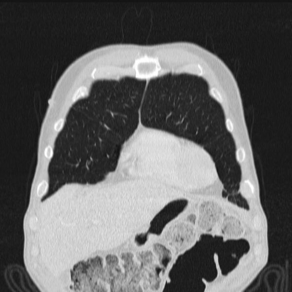 File:Azygos lobe (Radiopaedia 38259-40275 Coronal lung window 16).jpg