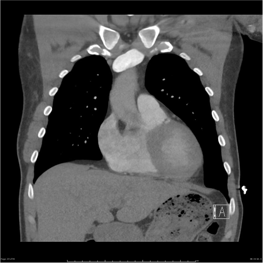 Azygos venous system anatomy (CT pulmonary angiography) (Radiopaedia 25928-26077 Coronal C+ CTPA 23).jpg
