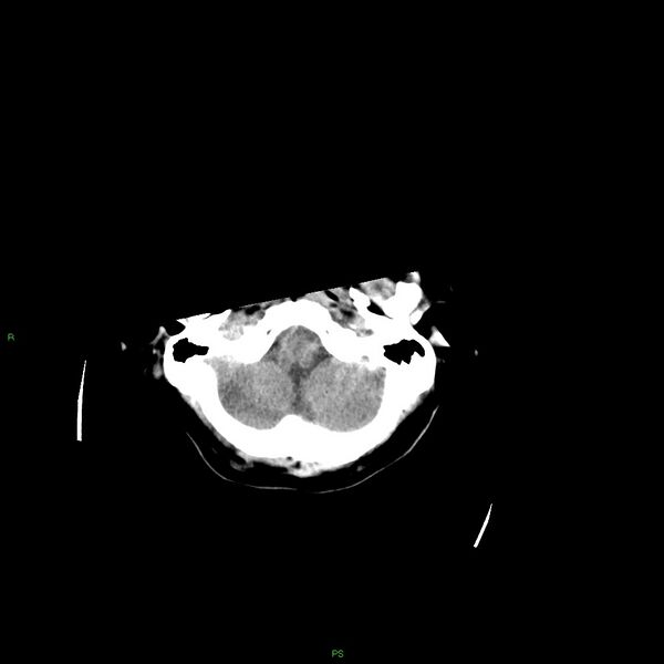 File:Basal ganglia hemorrhage (Radiopaedia 58349-65472 Axial non-contrast 50).jpg