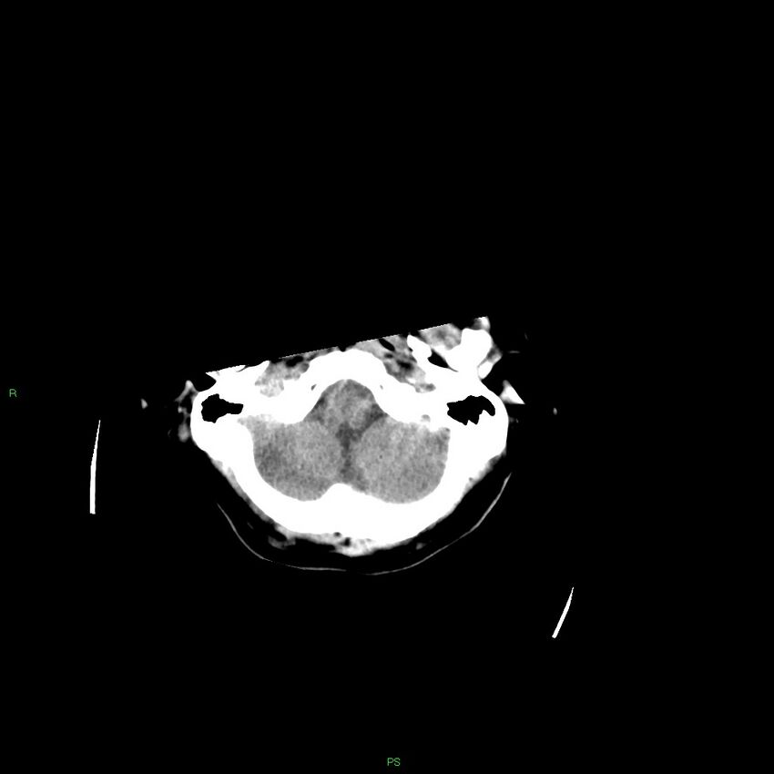 Basal ganglia hemorrhage (Radiopaedia 58349-65472 Axial non-contrast 50).jpg