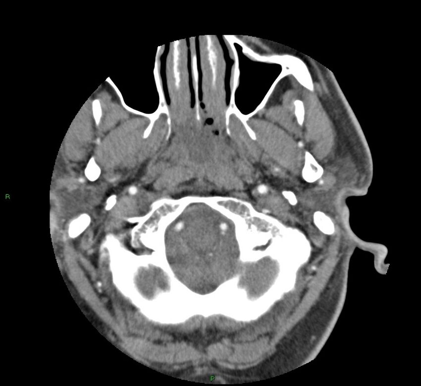 Basal ganglia hemorrhage (Radiopaedia 58763-65985 D 19).jpg