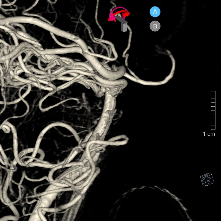 Basilar artery perforator aneurysm (Radiopaedia 82455-97734 3D view left VA 71).jpg