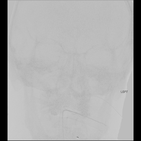 File:Basilar tip thrombus with endovascular clot retrieval (Radiopaedia 46320-50726 B 1).png