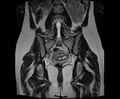 Bicornuate bicollis uterus (Radiopaedia 61626-69616 Coronal T2 22).jpg