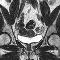 Bicornuate uterus (Radiopaedia 11104-11492 Coronal T2 8).jpg