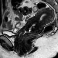 Bicornuate uterus (Radiopaedia 61974-70046 Sagittal T2 11).jpg