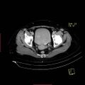 Bifid ureter (Radiopaedia 47604-52253 Axial C+ delayed 27).jpg