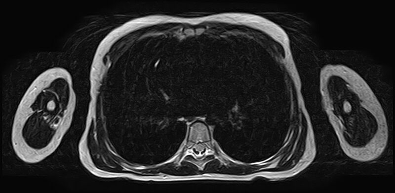 File:Bilateral Sprengel deformity with Klippel-Feil syndrome (Radiopaedia 66395-75650 Axial T2 34).jpg