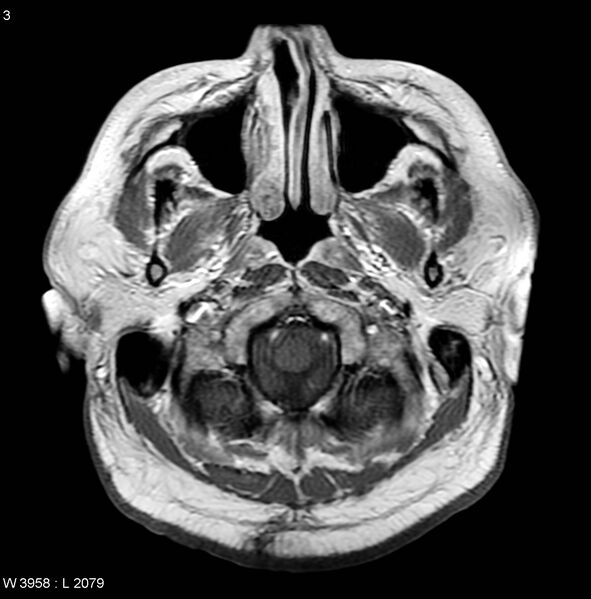 File:Bilateral acoustic schwannomas on a background of neurofibromatosis type 2 (Radiopaedia 5325).jpg