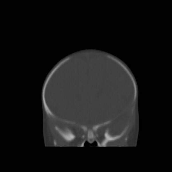 File:Bilateral cephalohematomas and subdural hematomas (Radiopaedia 26778-26929 Coronal bone window 3).jpg
