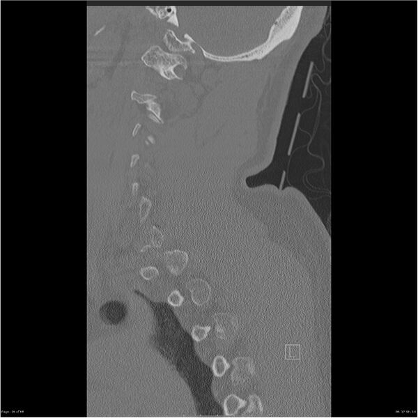 File:Bilateral cervical ribs (Radiopaedia 25868-26017 Sagittal bone window 16).jpg
