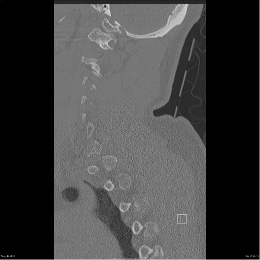 Bilateral cervical ribs (Radiopaedia 25868-26017 Sagittal bone window 16).jpg