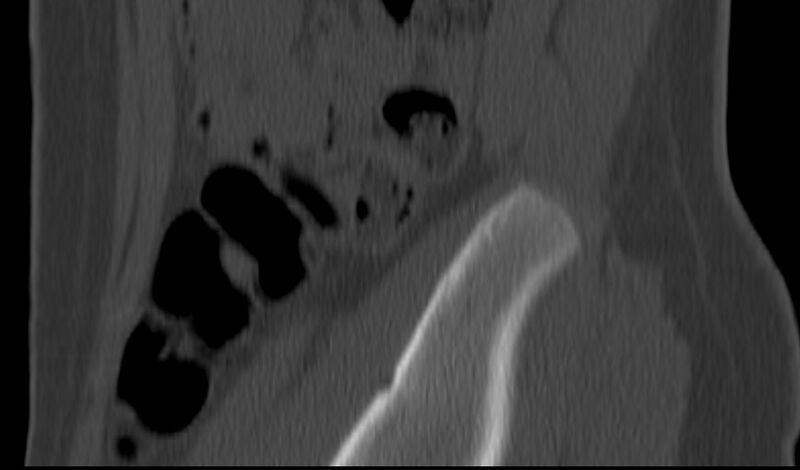 File:Bilateral pars defect (Radiopaedia 26691-26846 Sagittal bone window 65).jpg