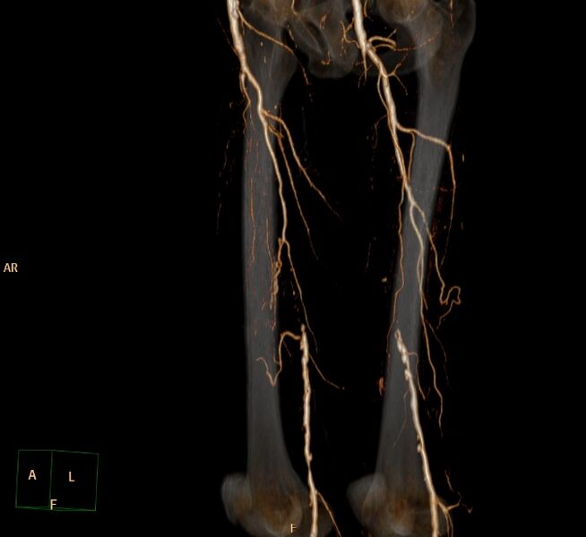 File:Bilateral superficial femoral arterial occlusion (Radiopaedia 25682-25857 3D VR 18).jpg