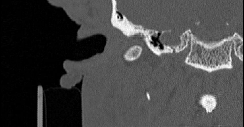 Bilateral temporal bone fractures (Radiopaedia 29482-29970 Coronal non-contrast 72).jpg